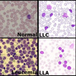 foto leocemia_saude em evidencia